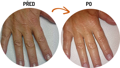 Speciální ošetření rukou